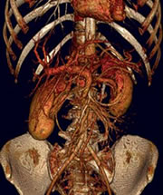 腹部3D画像(血管と骨)