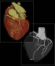 心臓(冠動脈CT)
