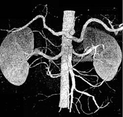 腹部血管CTアンジオグラフィーにより腹腔動脈、上腸間膜動脈、腎動脈などが描出されています。