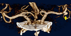 CTアンジオグラフィーにより左中大脳動脈の動脈瘤が描出されています。