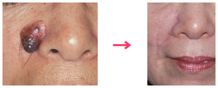 皮膚悪性腫瘍：切除後鼻がゆがまないよう皮膚をずらして再建します。