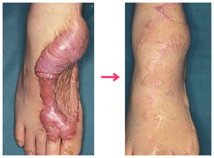 足背瘢痕ケロイド：ケロイドを切り取って皮膚移植します。