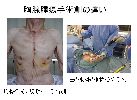 胸腺腫瘍手術創の違い