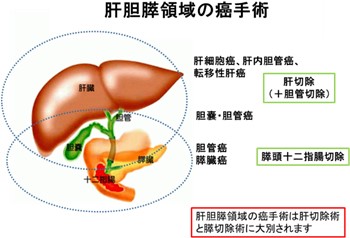肝胆膵領域の癌手術