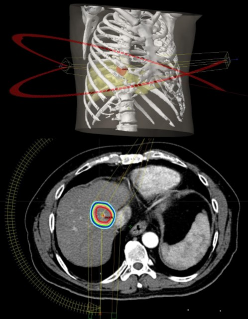肝細胞癌に対する体幹部定位放射線治療（ピンポイント治療）