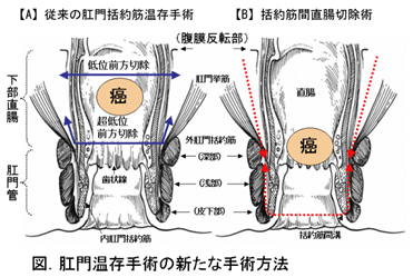 肛門温存手術の新たな手術方法