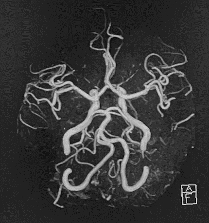造影剤を使用せずに頭部の血管を描出することが可能です。（MRA画像）