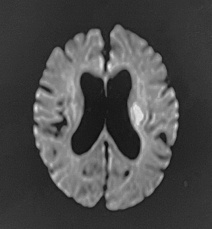 CTでは発見できない急性期の脳梗塞をとらえることにより、早期診断、早期治療を可能にします。（DWI画像）